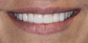 Bright, even smile with white, well-aligned teeth — close-up view