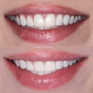 Lip-framed before and after — subtle enhancement for a polished, confident smile