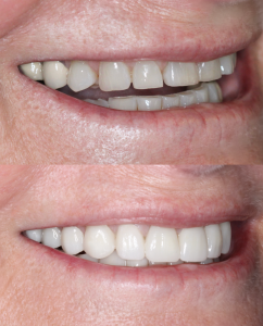 Before and after — brighter, straighter smile with improved tooth alignment