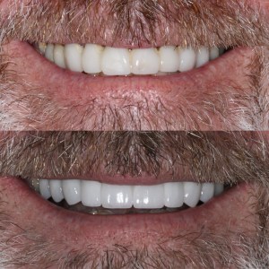 Man’s before and after — yellowed teeth become whiter, more uniform behind beard