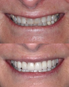 Smile makeover — uneven, worn teeth restored to natural-looking, bright finish