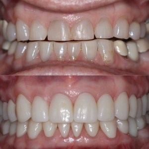 Close-up before and after — stained teeth transformed to white, even smile
